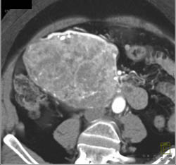 Islet Cell Tumor - CTisus CT Scan