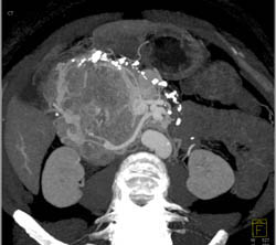 Islet Cell Tumor - CTisus CT Scan