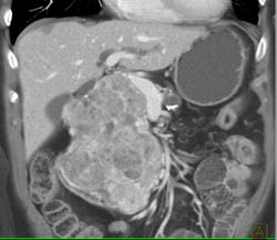 Islet Cell Tumor - CTisus CT Scan