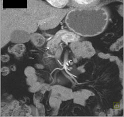 Islet Cell Tumor - CTisus CT Scan