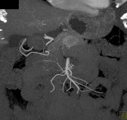 Islet Cell Tumor - CTisus CT Scan