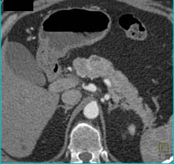 Islet Cell Tumor - CTisus CT Scan