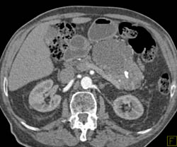 Cystadenoma - CTisus CT Scan