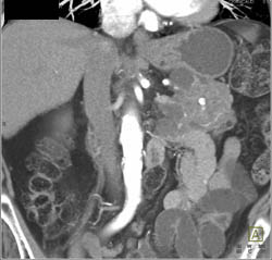 Cystadenoma - CTisus CT Scan