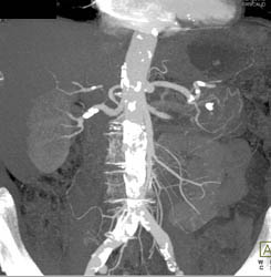 Cystadenoma - CTisus CT Scan