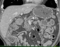 Cystic Mass in Uncinate With Obstructed Pancreatic Duct - CTisus CT Scan