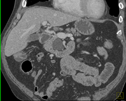 Intraductal Papillary Mucinous Neoplasm (IPMN) - CTisus CT Scan