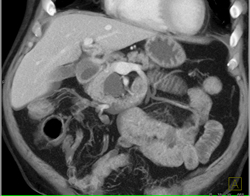 Intraductal Papillary Mucinous Neoplasm (IPMN) - CTisus CT Scan