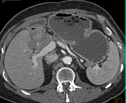 Delayed Gastric Emptying S/p Whipple Procedure - CTisus CT Scan