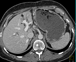 Delayed Gastric Emptying S/p Whipple Procedure - CTisus CT Scan