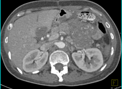 Angiosarcoma of the Pancreas - CTisus CT Scan