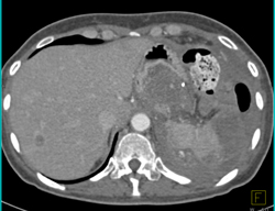 Angiosarcoma of the Pancreas - CTisus CT Scan