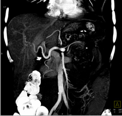 Angiosarcoma of the Pancreas - CTisus CT Scan