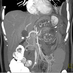 Angiosarcoma of the Pancreas - CTisus CT Scan