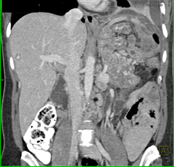 Angiosarcoma of the Pancreas - CTisus CT Scan