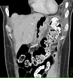 Angiosarcoma of the Pancreas - CTisus CT Scan