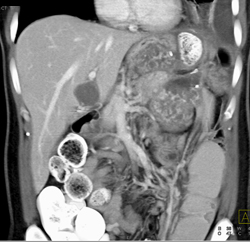 Angiosarcoma of the Pancreas - CTisus CT Scan