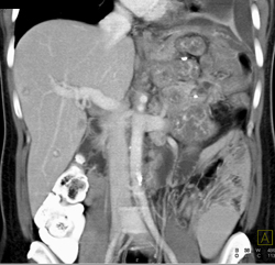 Angiosarcoma of the Pancreas - CTisus CT Scan