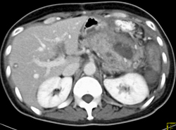 Angiosarcoma of the Pancreas - CTisus CT Scan