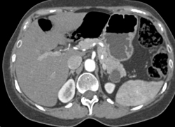 Intraductal Papillary Mucinous Neoplasm (IPMN) - CTisus CT Scan