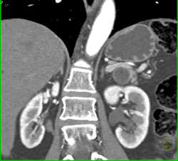 Intraductal Papillary Mucinous Neoplasm (IPMN) - CTisus CT Scan