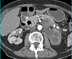 Pancreatic Cancer Obstructs and Invades the Left Kidney. Splenic Artery and Vein Also Involved- See Full Sequence - CTisus CT Scan