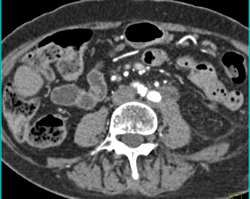 Pancreatic Cancer Obstructs and Invades the Left Kidney. Splenic Artery and Vein Also Involved- See Full Sequence - CTisus CT Scan