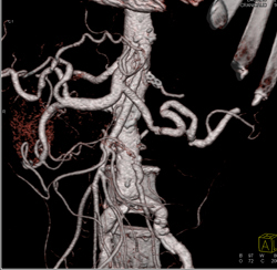 Pancreatic Cancer Obstructs and Invades the Left Kidney. Splenic Artery and Vein Also Involved- See Full Sequence - CTisus CT Scan