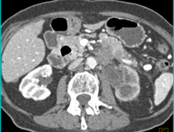 Pancreatic Cancer Obstructs and Invades the Left Kidney. Splenic Artery and Vein Also Involved- See Full Sequence - CTisus CT Scan