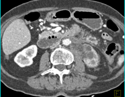 Pancreatic Cancer Obstructs and Invades the Left Kidney. Splenic Artery and Vein Also Involved- See Full Sequence - CTisus CT Scan