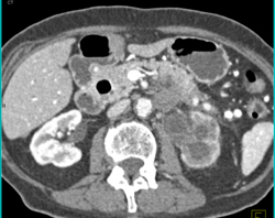 Pancreatic Cancer Obstructs and Invades the Left Kidney. Splenic Artery and Vein Also Involved- See Full Sequence - CTisus CT Scan