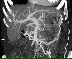 Pancreatic Cancer Obstructs and Invades the Left Kidney. Splenic Artery and Vein Also Involved- See Full Sequence - CTisus CT Scan