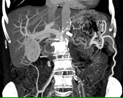 Pancreatic Cancer Obstructs and Invades the Left Kidney. Splenic Artery and Vein Also Involved- See Full Sequence - CTisus CT Scan