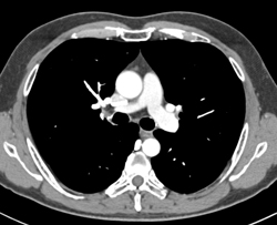 Pseudocyst S/p Distal Pancreatectomy and Splenectomy - CTisus CT Scan