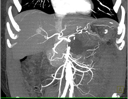 Pseudocyst S/p Distal Pancreatectomy and Splenectomy - CTisus CT Scan