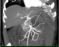 Pseudocyst S/p Distal Pancreatectomy and Splenectomy - CTisus CT Scan