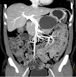 Pseudocyst S/p Distal Pancreatectomy and Splenectomy - CTisus CT Scan