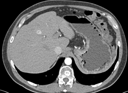 Liver Metastases S/p Distal Pancreatectoy and Splenectomy for Islet Cell Tumor - CTisus CT Scan