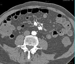 Dysplasia Arises in Intraductal Papillary Mucinous Neoplasm (IPMN) and Sclerosing Mesenteritis- What A Case! - CTisus CT Scan