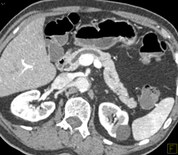 Dysplasia Arises in Intraductal Papillary Mucinous Neoplasm (IPMN) and Sclerosing Mesenteritis- What A Case! - CTisus CT Scan