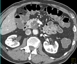 Dysplasia Arises in Intraductal Papillary Mucinous Neoplasm (IPMN) and Sclerosing Mesenteritis- What A Case! - CTisus CT Scan