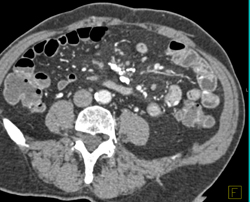 Dysplasia Arises in Intraductal Papillary Mucinous Neoplasm (IPMN) and Sclerosing Mesenteritis- What A Case! - CTisus CT Scan