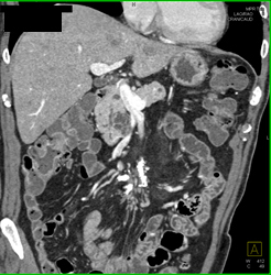 Dysplasia Arises in Intraductal Papillary Mucinous Neoplasm (IPMN) and Sclerosing Mesenteritis- What A Case! - CTisus CT Scan