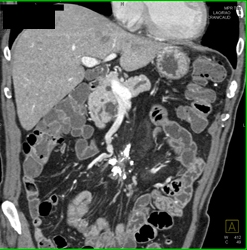 Dysplasia Arises in Intraductal Papillary Mucinous Neoplasm (IPMN) and Sclerosing Mesenteritis- What A Case! - CTisus CT Scan