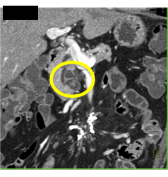 Dysplasia Arises in Intraductal Papillary Mucinous Neoplasm (IPMN) and Sclerosing Mesenteritis- What A Case! - CTisus CT Scan