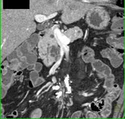 Dysplasia Arises in Intraductal Papillary Mucinous Neoplasm (IPMN) and Sclerosing Mesenteritis- What A Case! - CTisus CT Scan