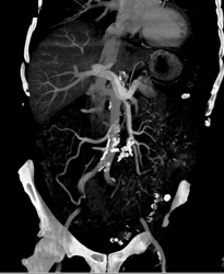 Dysplasia Arises in Intraductal Papillary Mucinous Neoplasm (IPMN) and Sclerosing Mesenteritis- What A Case! - CTisus CT Scan