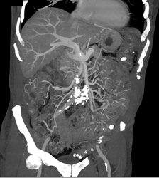 Dysplasia Arises in Intraductal Papillary Mucinous Neoplasm (IPMN) and Sclerosing Mesenteritis- What A Case! - CTisus CT Scan