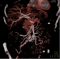 Dysplasia Arises in Intraductal Papillary Mucinous Neoplasm (IPMN) and Sclerosing Mesenteritis- What A Case! - CTisus CT Scan