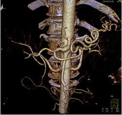 Excellent Example of High Opacity VRT to Define Mesenteric Arteries- See Full Sequence - CTisus CT Scan